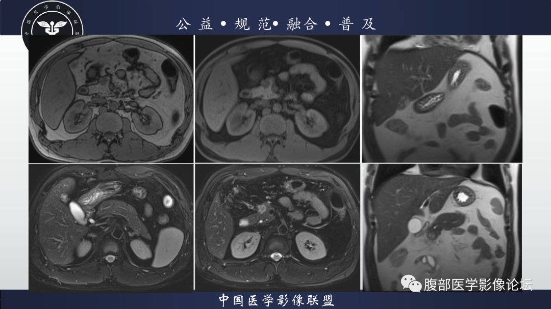影像PPT - 【病例】胰腺高分化导管腺癌1例CT及MR影像-5