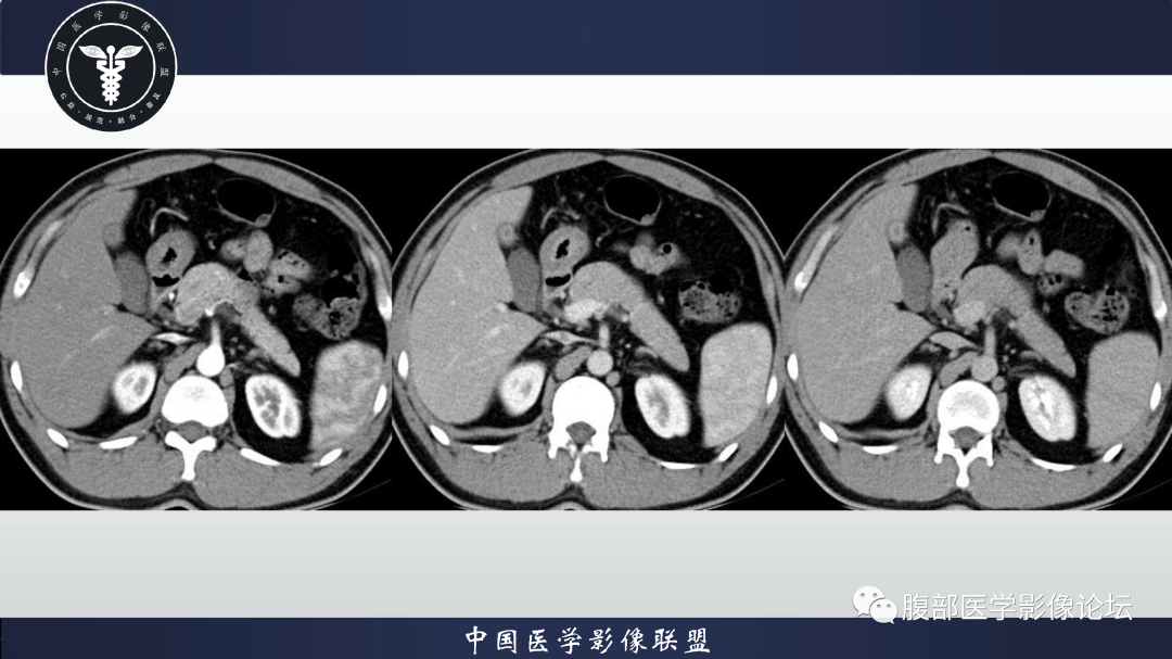影像PPT - 【病例】胰腺高分化导管腺癌1例CT及MR影像-3