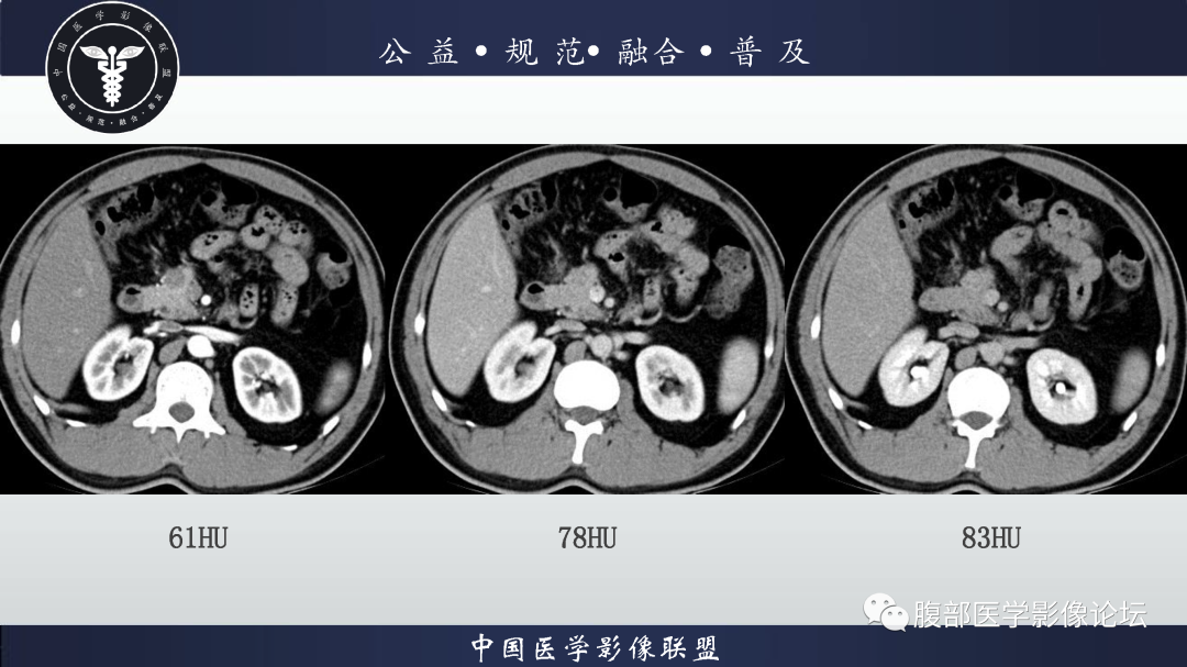 影像PPT - 【病例】胰腺高分化导管腺癌1例CT及MR影像-4