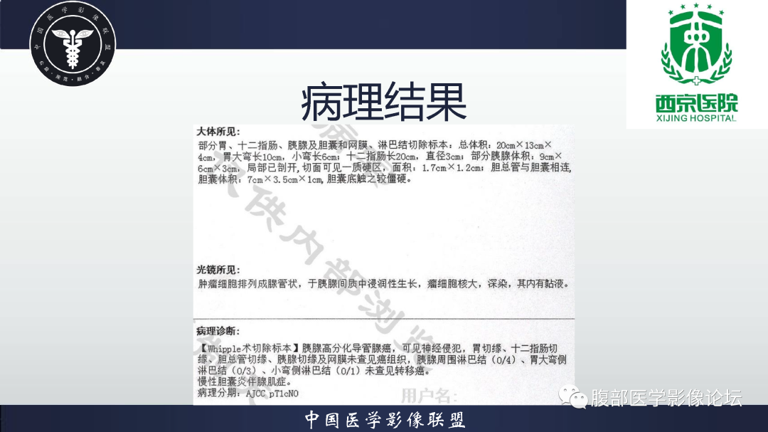 影像PPT - 【病例】胰腺高分化导管腺癌1例CT及MR影像-9