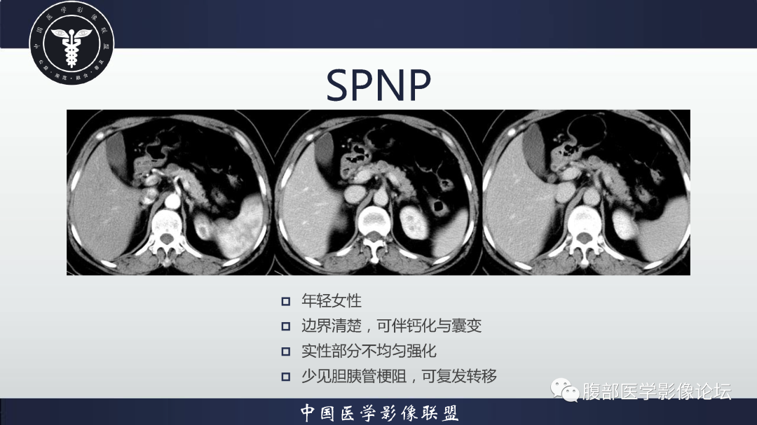 影像PPT - 【病例】胰腺高分化导管腺癌1例CT及MR影像-15
