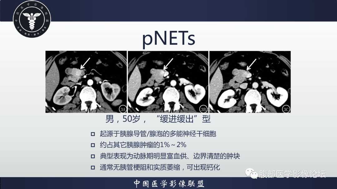 影像PPT - 【病例】胰腺高分化导管腺癌1例CT及MR影像-16