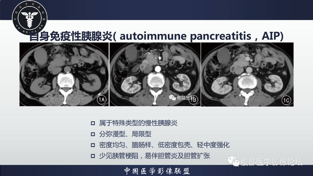 影像PPT - 【病例】胰腺高分化导管腺癌1例CT及MR影像-17