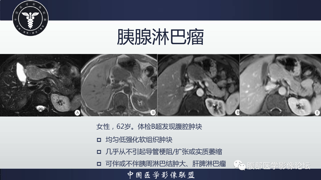 影像PPT - 【病例】胰腺高分化导管腺癌1例CT及MR影像-18