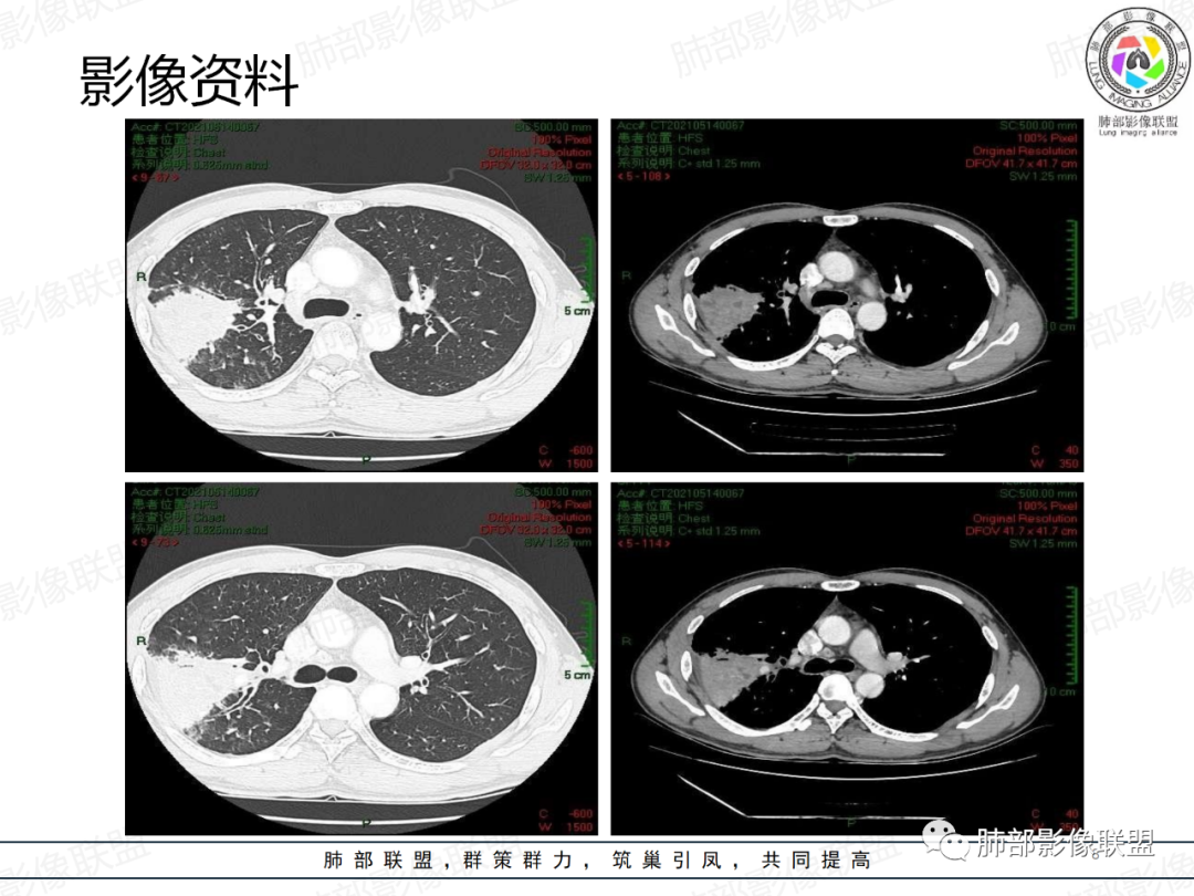 影像PPT - 【病例】中年男性,痰血,楔形跨段病变分析思路-8 影像PPT - 【病例】中年男性,痰血,楔形跨段病变分析思路-8