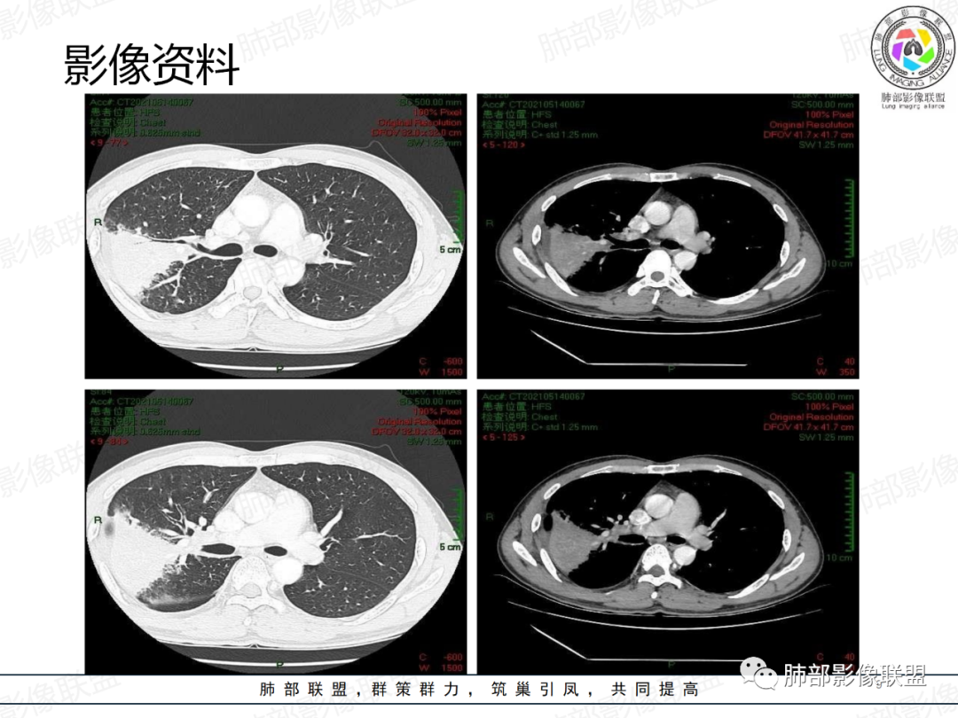影像PPT - 【病例】中年男性,痰血,楔形跨段病变分析思路-9 影像PPT - 【病例】中年男性,痰血,楔形跨段病变分析思路-9