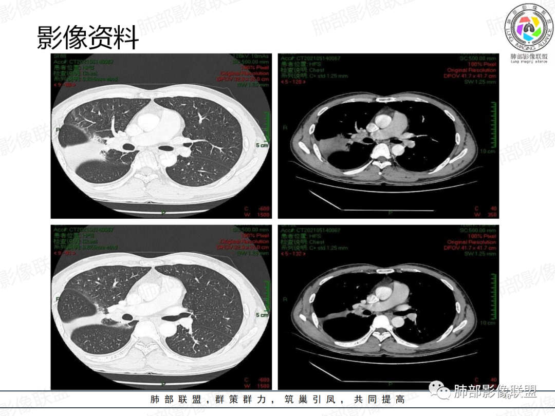 影像PPT - 【病例】中年男性,痰血,楔形跨段病变分析思路-10 影像PPT - 【病例】中年男性,痰血,楔形跨段病变分析思路-10