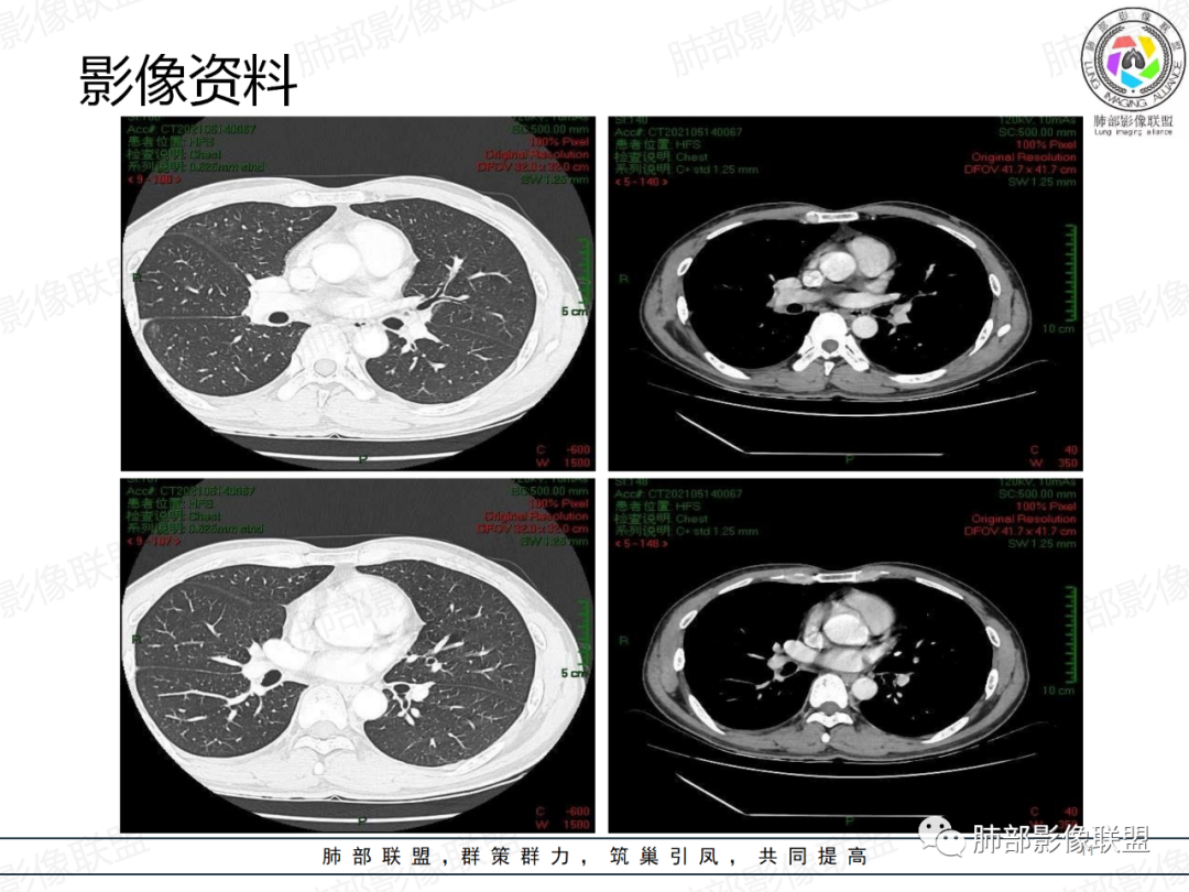 影像PPT - 【病例】中年男性,痰血,楔形跨段病变分析思路-11 影像PPT - 【病例】中年男性,痰血,楔形跨段病变分析思路-11
