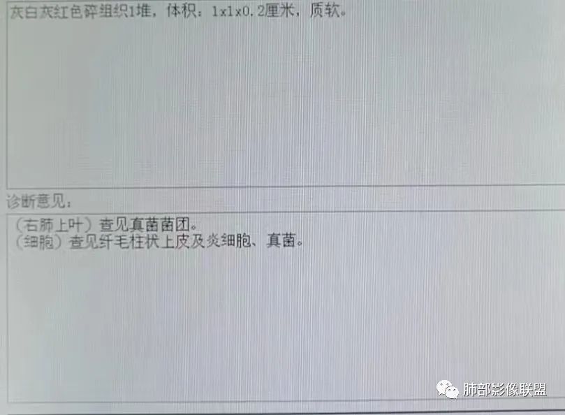 影像PPT - 【病例】中年男性,痰血,楔形跨段病变分析思路-24 影像PPT - 【病例】中年男性,痰血,楔形跨段病变分析思路-24