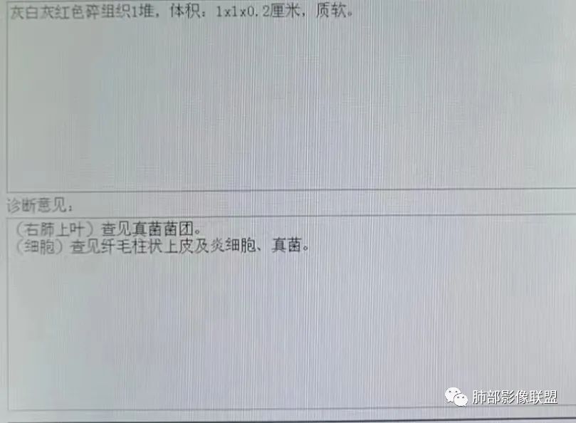 影像PPT - 【病例】中年男性,痰血,楔形跨段病变分析思路-30 影像PPT - 【病例】中年男性,痰血,楔形跨段病变分析思路-30