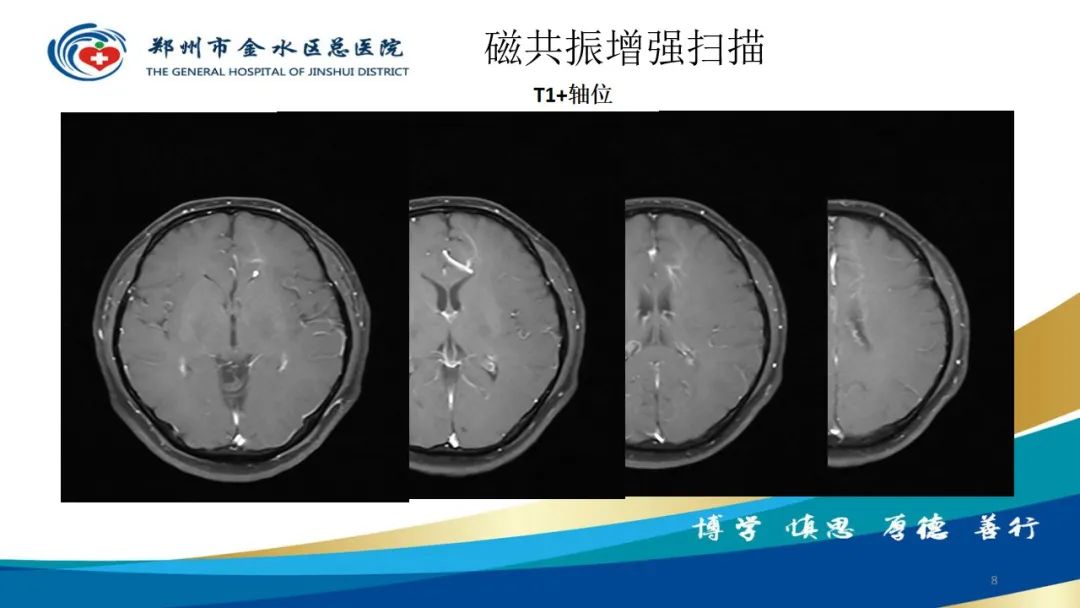 影像PPT - 【病例】脑内静脉畸形1例CT及MR影像-8
