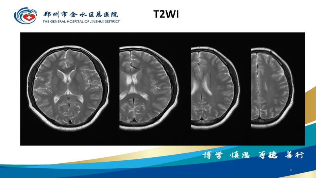 影像PPT - 【病例】脑内静脉畸形1例CT及MR影像-6