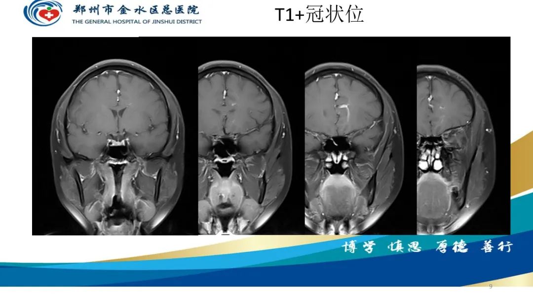 影像PPT - 【病例】脑内静脉畸形1例CT及MR影像-9
