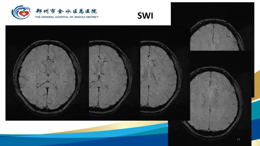 影像PPT - 【病例】脑内静脉畸形1例CT及MR影像-11