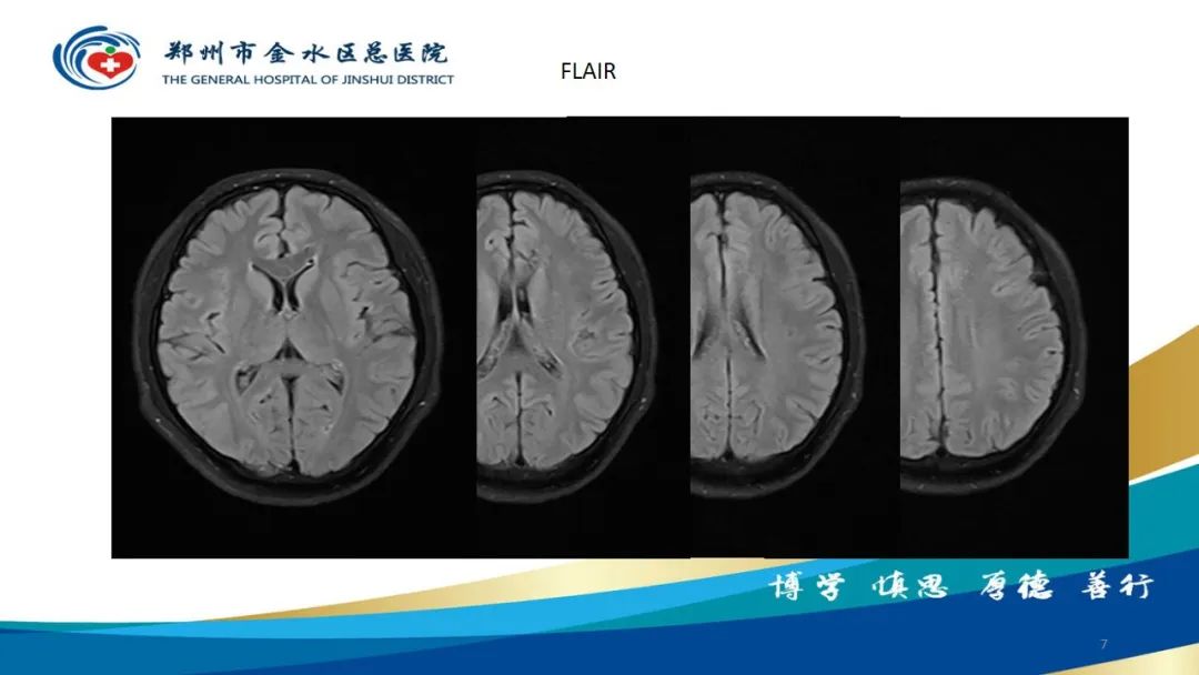 影像PPT - 【病例】脑内静脉畸形1例CT及MR影像-7