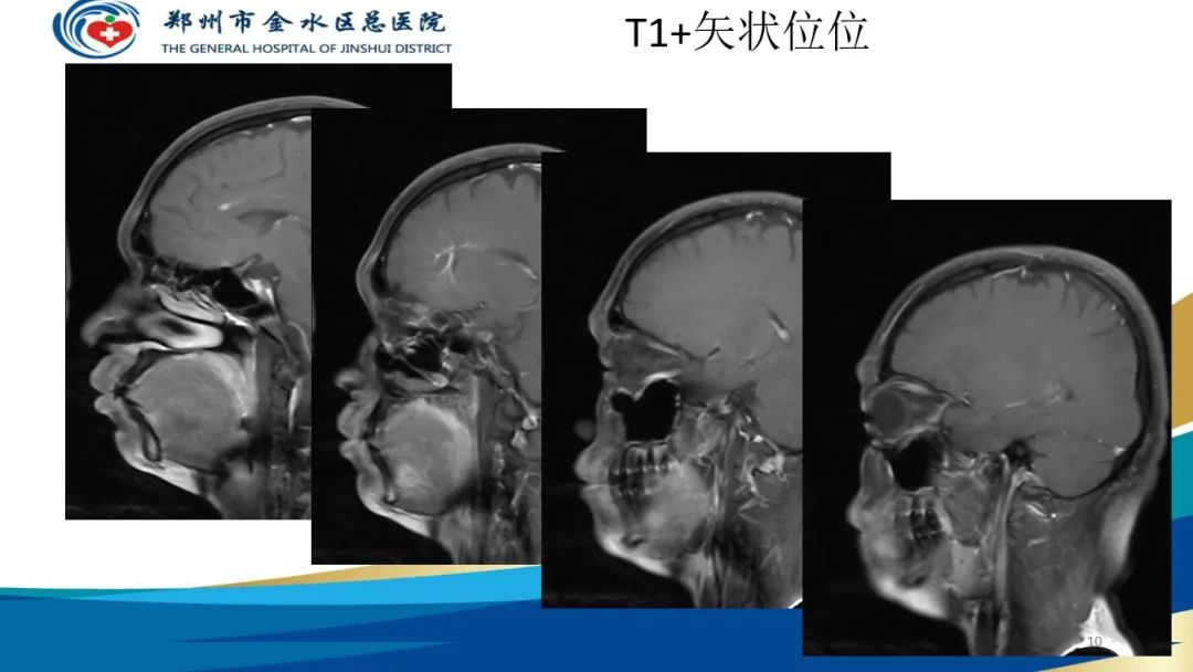 影像PPT - 【病例】脑内静脉畸形1例CT及MR影像-10