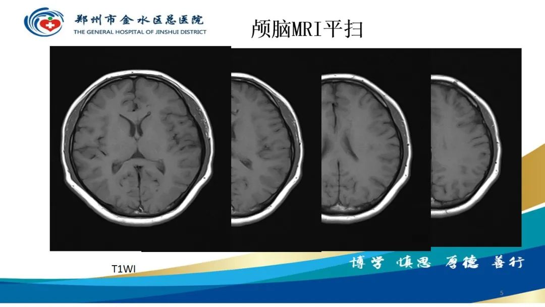 影像PPT - 【病例】脑内静脉畸形1例CT及MR影像-5