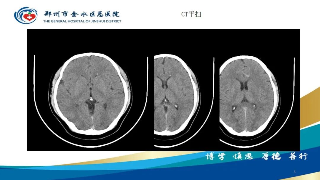 影像PPT - 【病例】脑内静脉畸形1例CT及MR影像-3