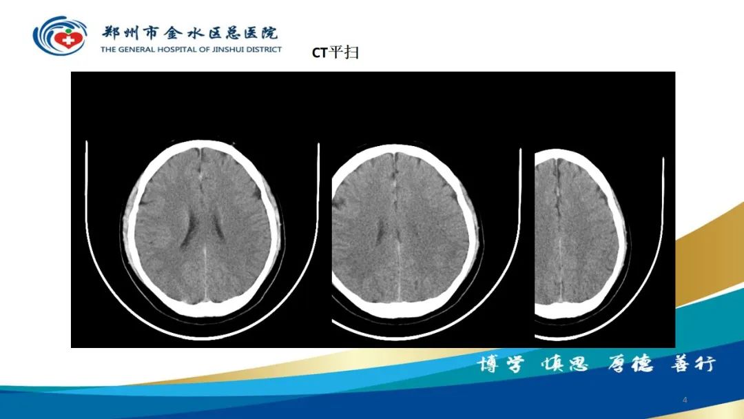影像PPT - 【病例】脑内静脉畸形1例CT及MR影像-4