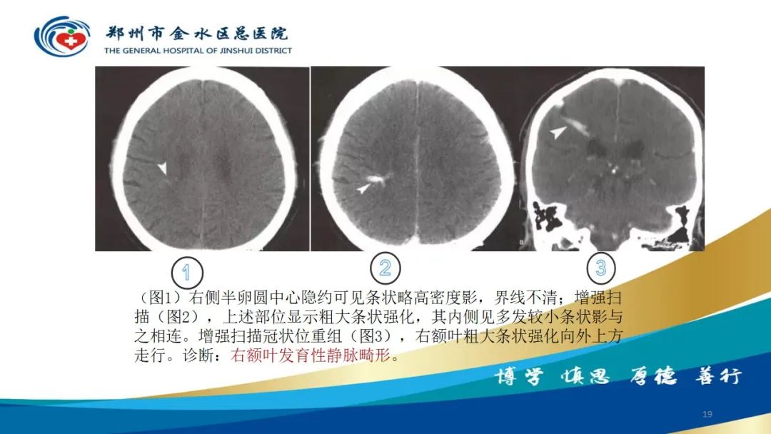 影像PPT - 【病例】脑内静脉畸形1例CT及MR影像-19