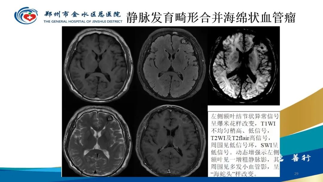 影像PPT - 【病例】脑内静脉畸形1例CT及MR影像-29