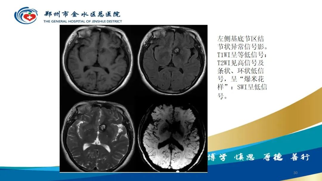 影像PPT - 【病例】脑内静脉畸形1例CT及MR影像-30