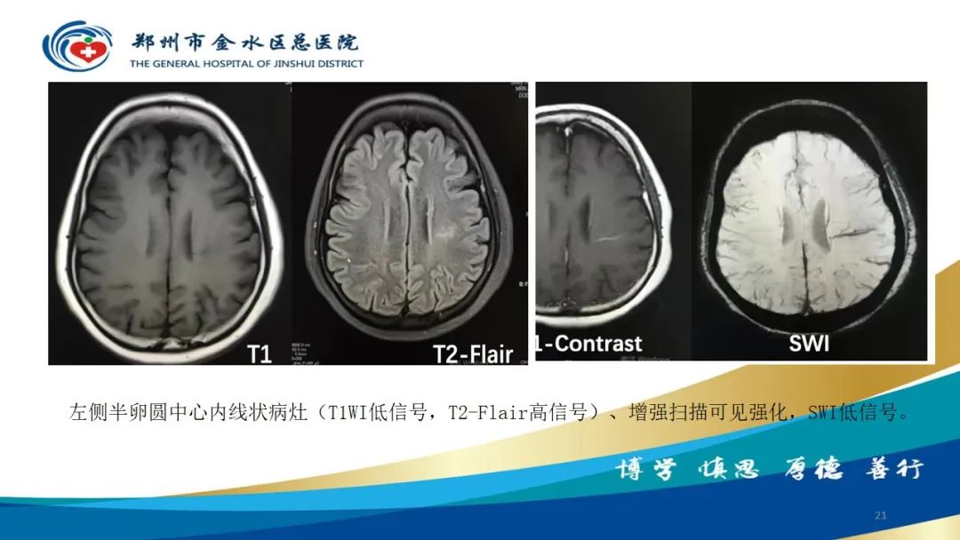 影像PPT - 【病例】脑内静脉畸形1例CT及MR影像-21