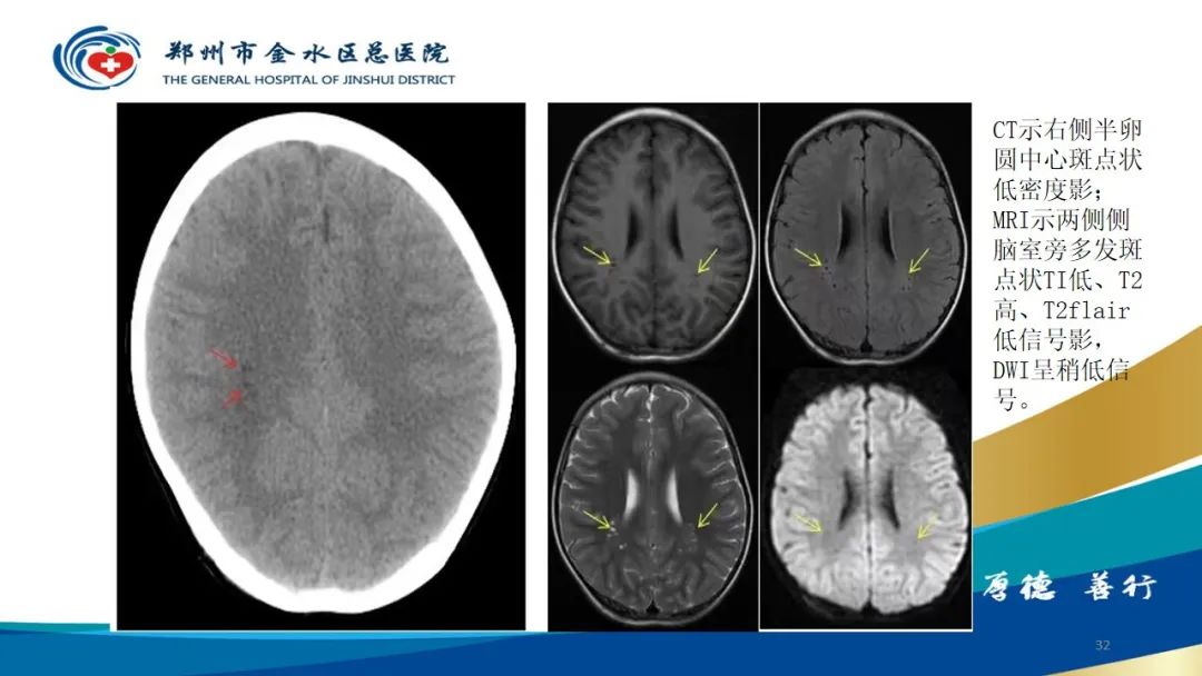 影像PPT - 【病例】脑内静脉畸形1例CT及MR影像-32