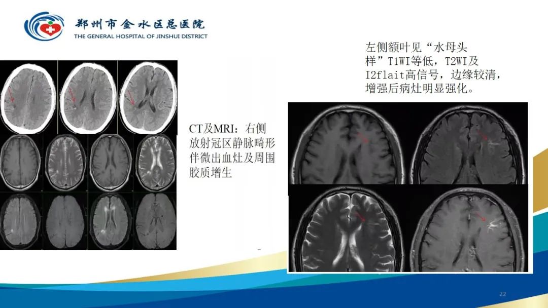 影像PPT - 【病例】脑内静脉畸形1例CT及MR影像-22