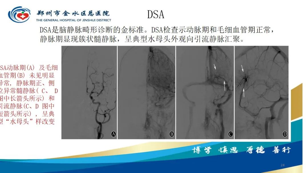 影像PPT - 【病例】脑内静脉畸形1例CT及MR影像-24