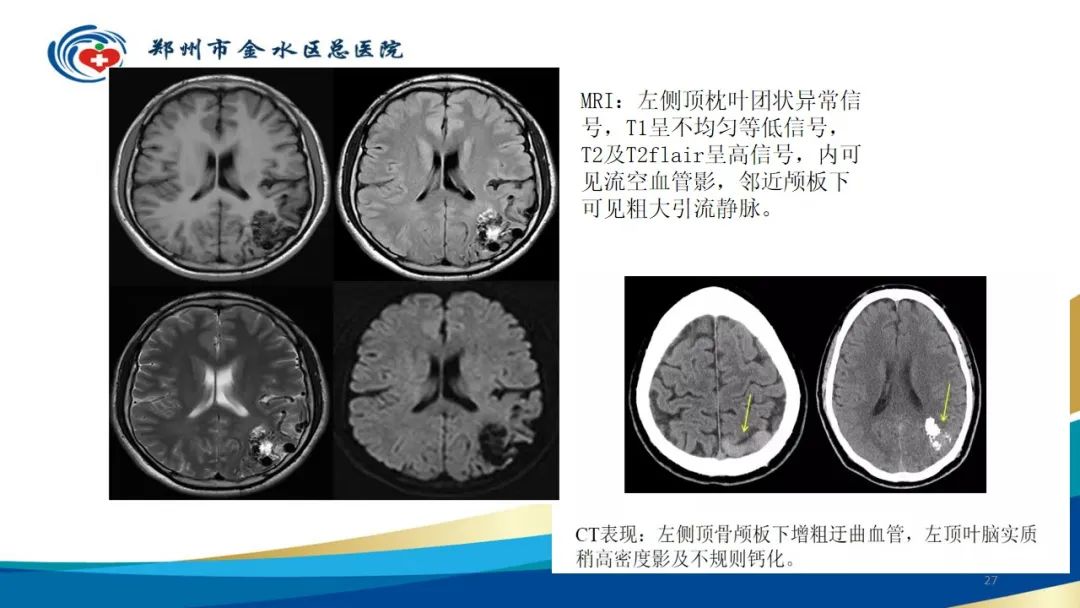 影像PPT - 【病例】脑内静脉畸形1例CT及MR影像-27