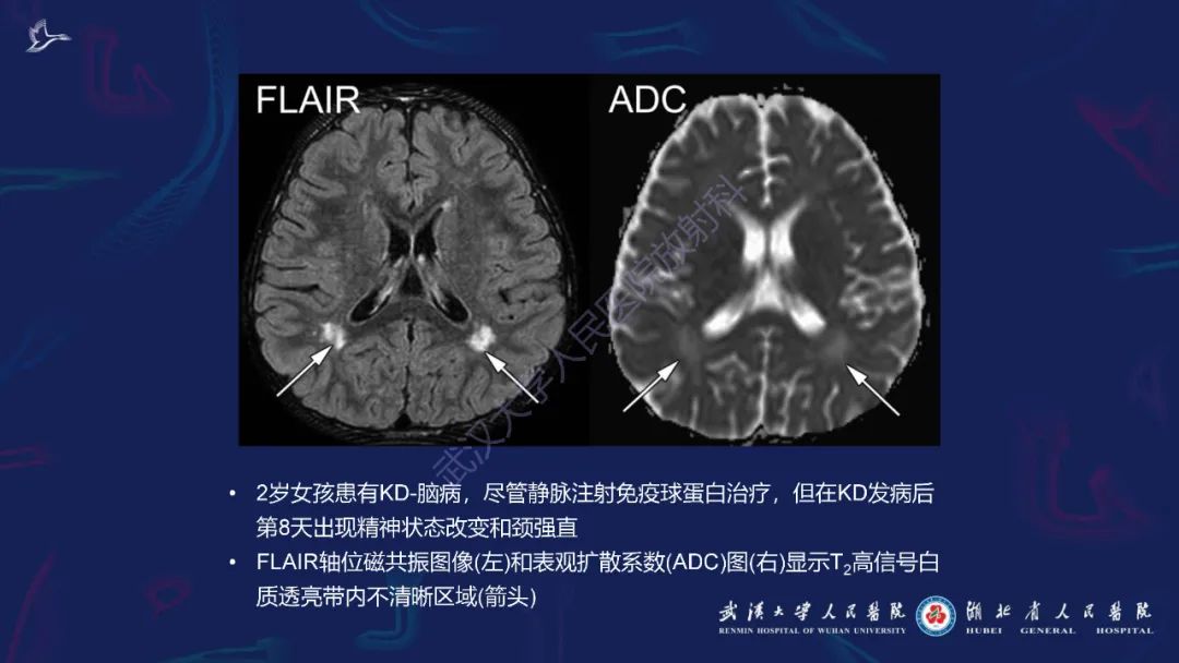 影像PPT - 【PPT】川崎病多系统受累影像诊断-7