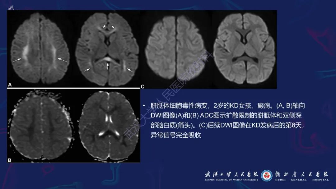 影像PPT - 【PPT】川崎病多系统受累影像诊断-8