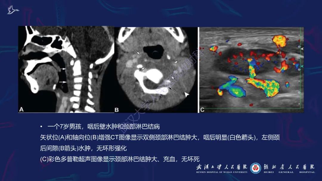 影像PPT - 【PPT】川崎病多系统受累影像诊断-12
