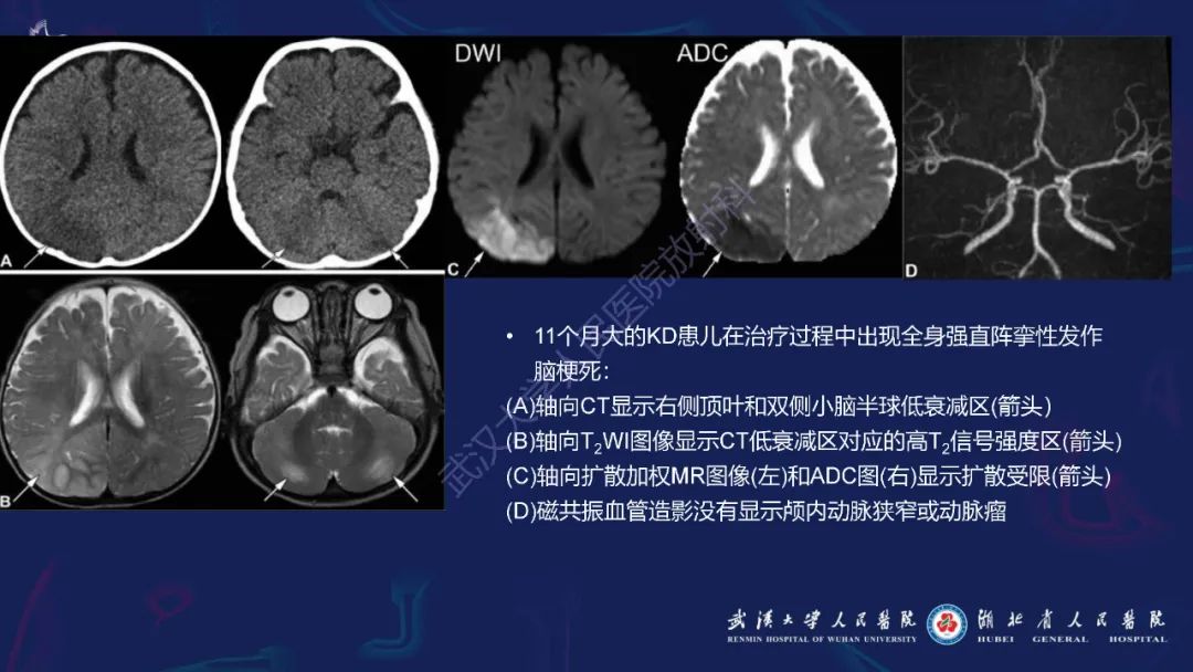 影像PPT - 【PPT】川崎病多系统受累影像诊断-9