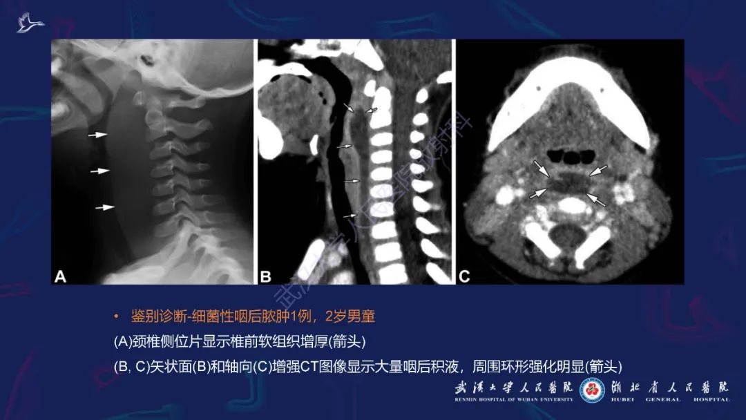 影像PPT - 【PPT】川崎病多系统受累影像诊断-13