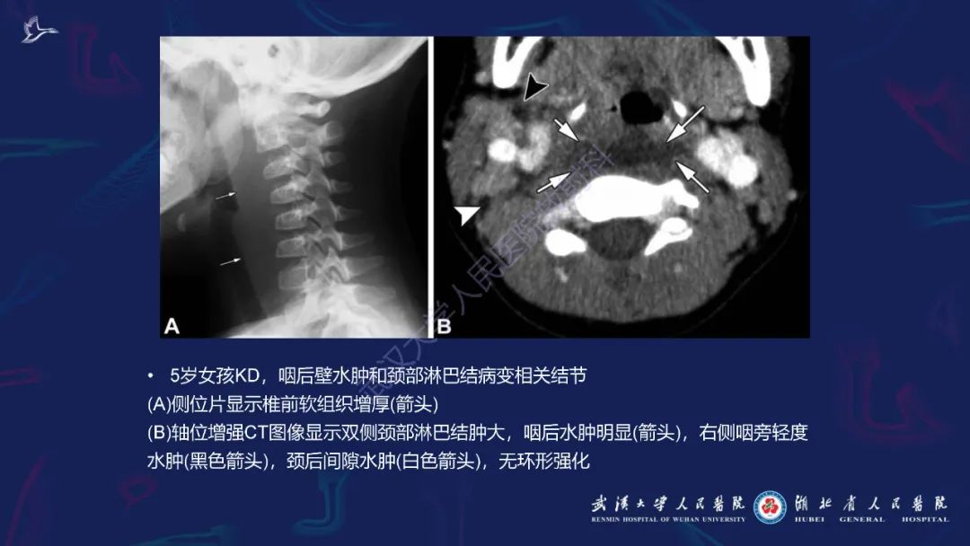 影像PPT - 【PPT】川崎病多系统受累影像诊断-11