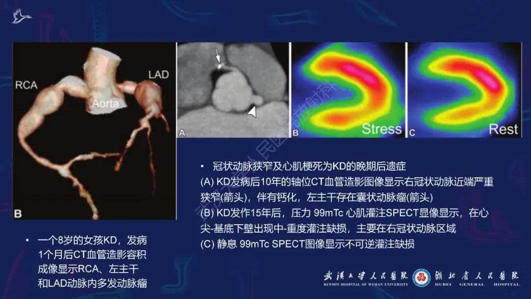 影像PPT - 【PPT】川崎病多系统受累影像诊断-17