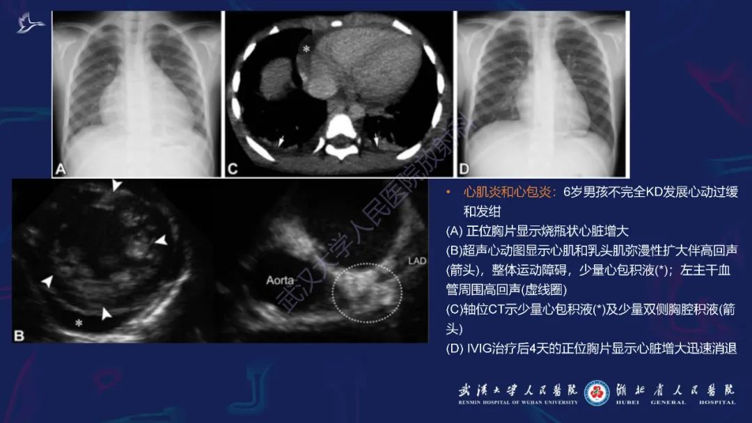 影像PPT - 【PPT】川崎病多系统受累影像诊断-18