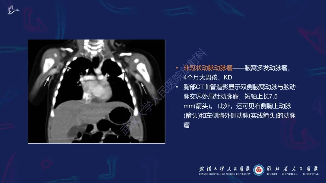 影像PPT - 【PPT】川崎病多系统受累影像诊断-20