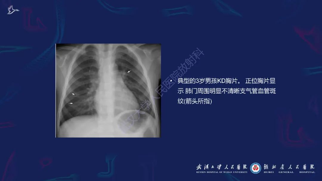 影像PPT - 【PPT】川崎病多系统受累影像诊断-22
