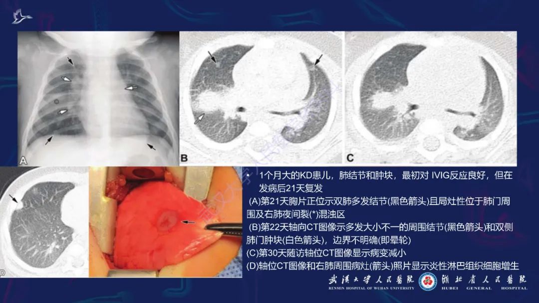 影像PPT - 【PPT】川崎病多系统受累影像诊断-23