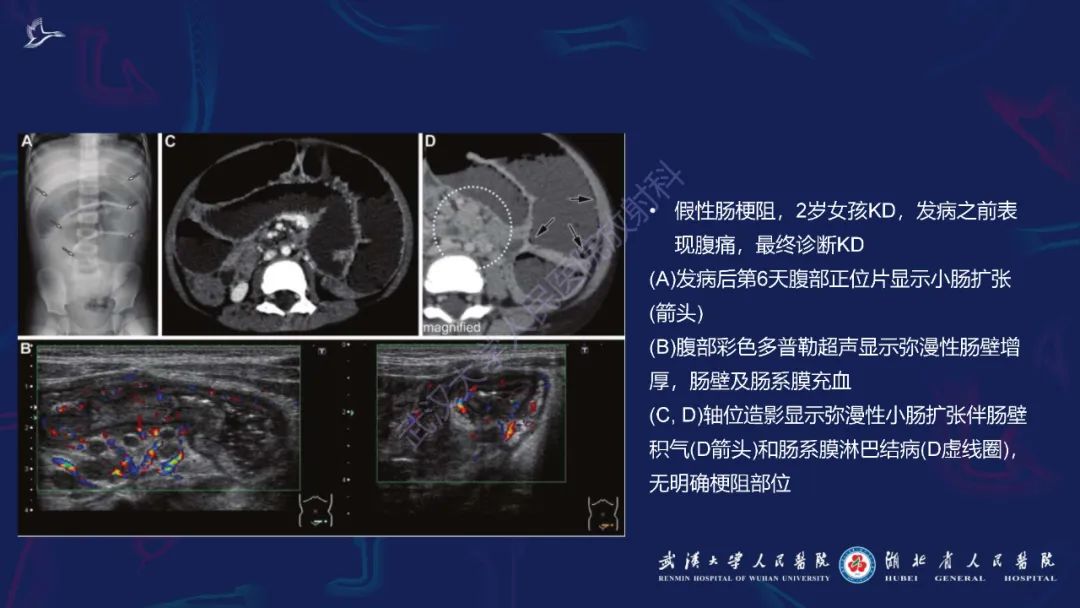 影像PPT - 【PPT】川崎病多系统受累影像诊断-25