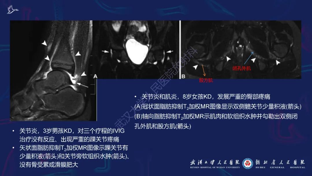 影像PPT - 【PPT】川崎病多系统受累影像诊断-29