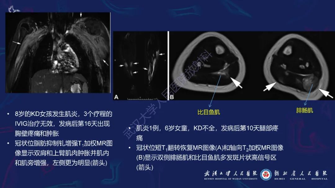 影像PPT - 【PPT】川崎病多系统受累影像诊断-30