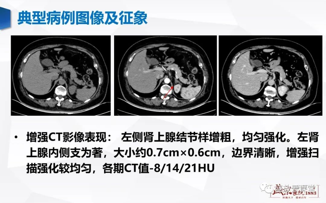 影像PPT - 【PPT】肾上腺增生 肾上腺腺瘤-4 影像PPT - 【PPT】肾上腺增生 肾上腺腺瘤-4