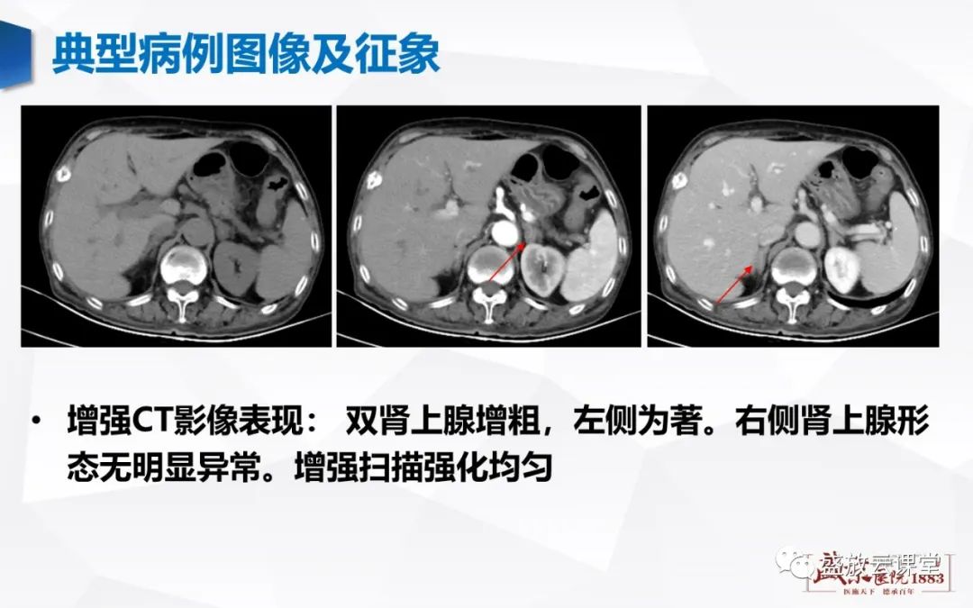 影像PPT - 【PPT】肾上腺增生 肾上腺腺瘤-9 影像PPT - 【PPT】肾上腺增生 肾上腺腺瘤-9