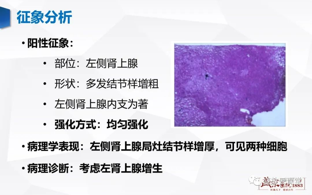 影像PPT - 【PPT】肾上腺增生 肾上腺腺瘤-7 影像PPT - 【PPT】肾上腺增生 肾上腺腺瘤-7