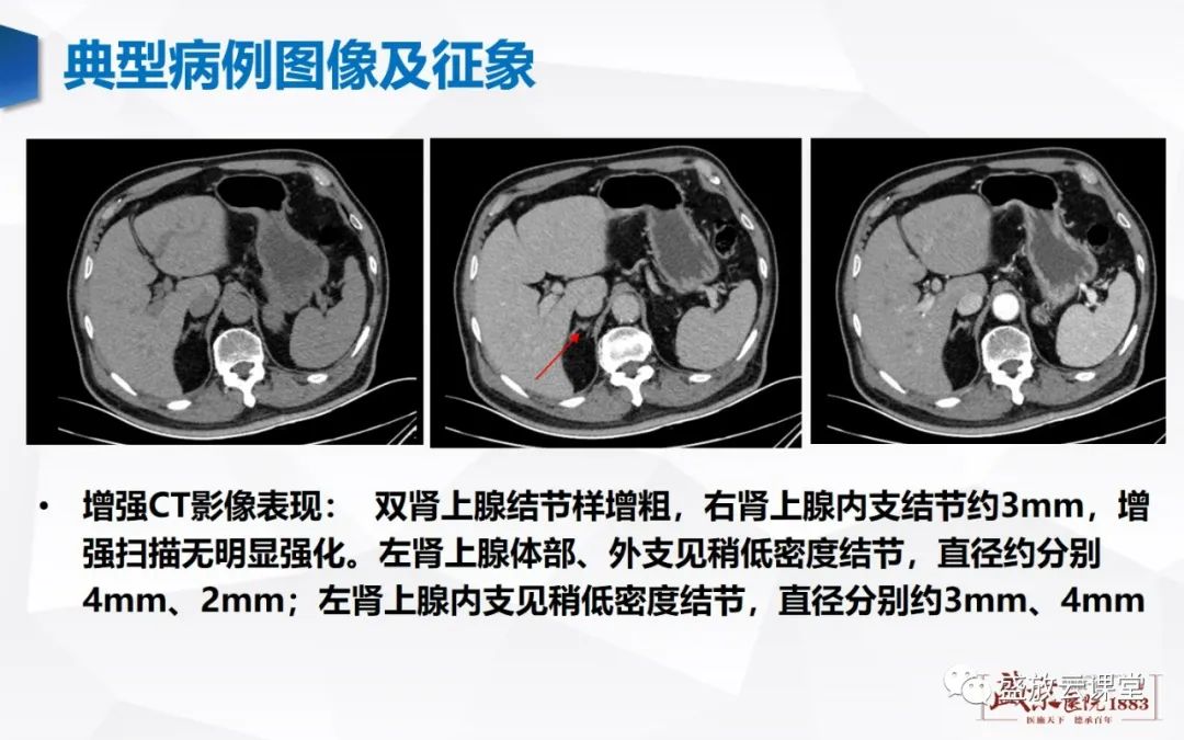 影像PPT - 【PPT】肾上腺增生 肾上腺腺瘤-13 影像PPT - 【PPT】肾上腺增生 肾上腺腺瘤-13