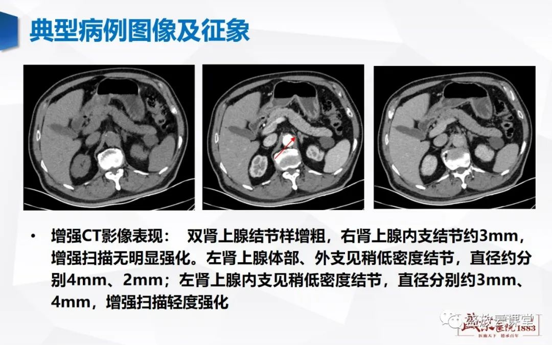 影像PPT - 【PPT】肾上腺增生 肾上腺腺瘤-14 影像PPT - 【PPT】肾上腺增生 肾上腺腺瘤-14